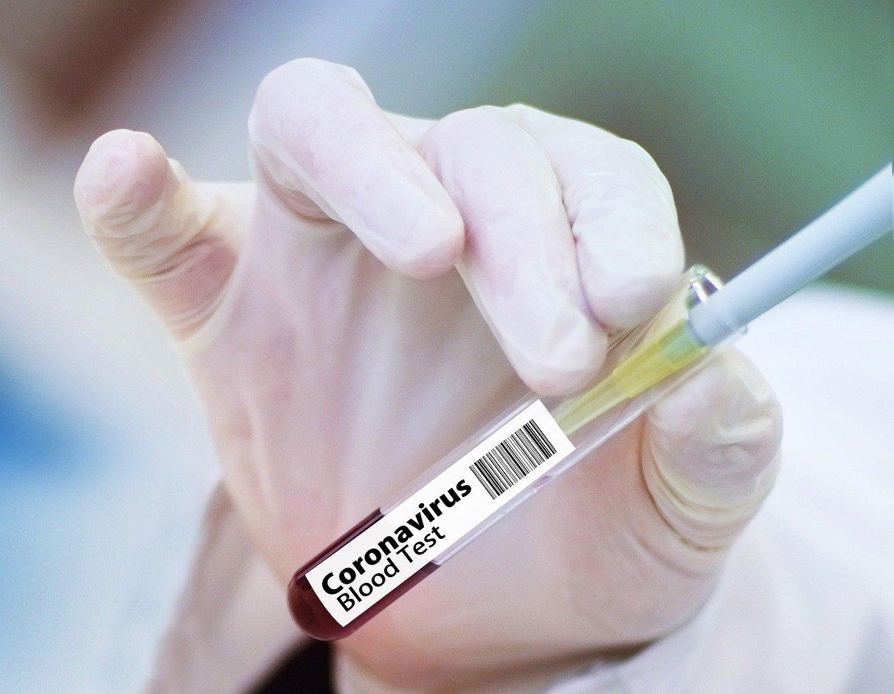 Фото Опасно ли делать прививку от ковида, если есть антитела – какие должны быть показатели в тесте 4