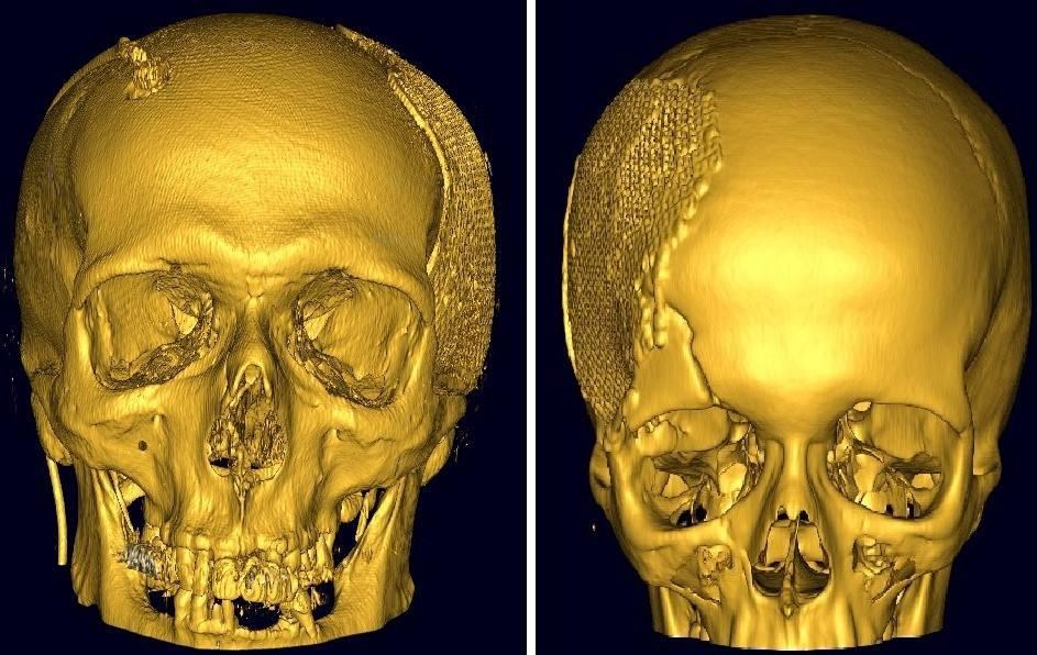 Новосибирские нейрохирурги нашли способ изменить форму черепа - sib.fm