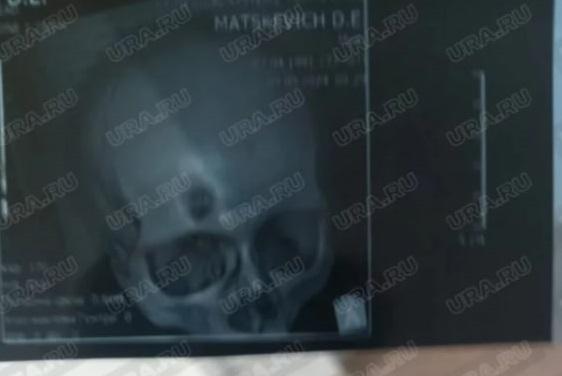 Фото Боец СВО с дырой в голове выжил в «Бахмутской мясорубке» - фото ранения уральского счастливчика 2 - Сиб.ФМ Фото Боец СВО с дырой в голове выжил в «Бахмутской мясорубке» - фото ранения уральского счастливчика 2