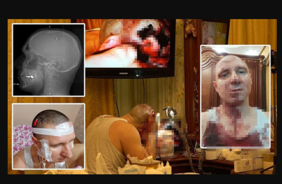 Фото «Это был ад»: исследователь из Новосибирска Михаил Радуга рассказал, зачем просверлил череп дрелью 2