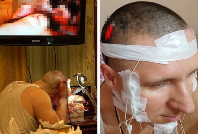 Фото Врач из Новосибирска обещал вскрывшему себе череп блогеру  инсульт и эпилепсию 2