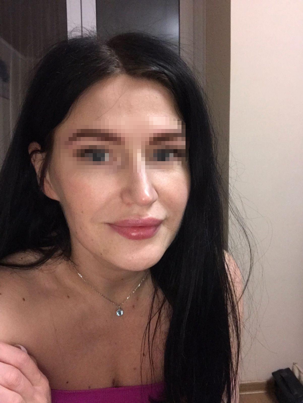 Фото «Будто кипяток под кожей»: жительница Новосибирска получила отёк Квинке после процедуры у косметолога на дому 2