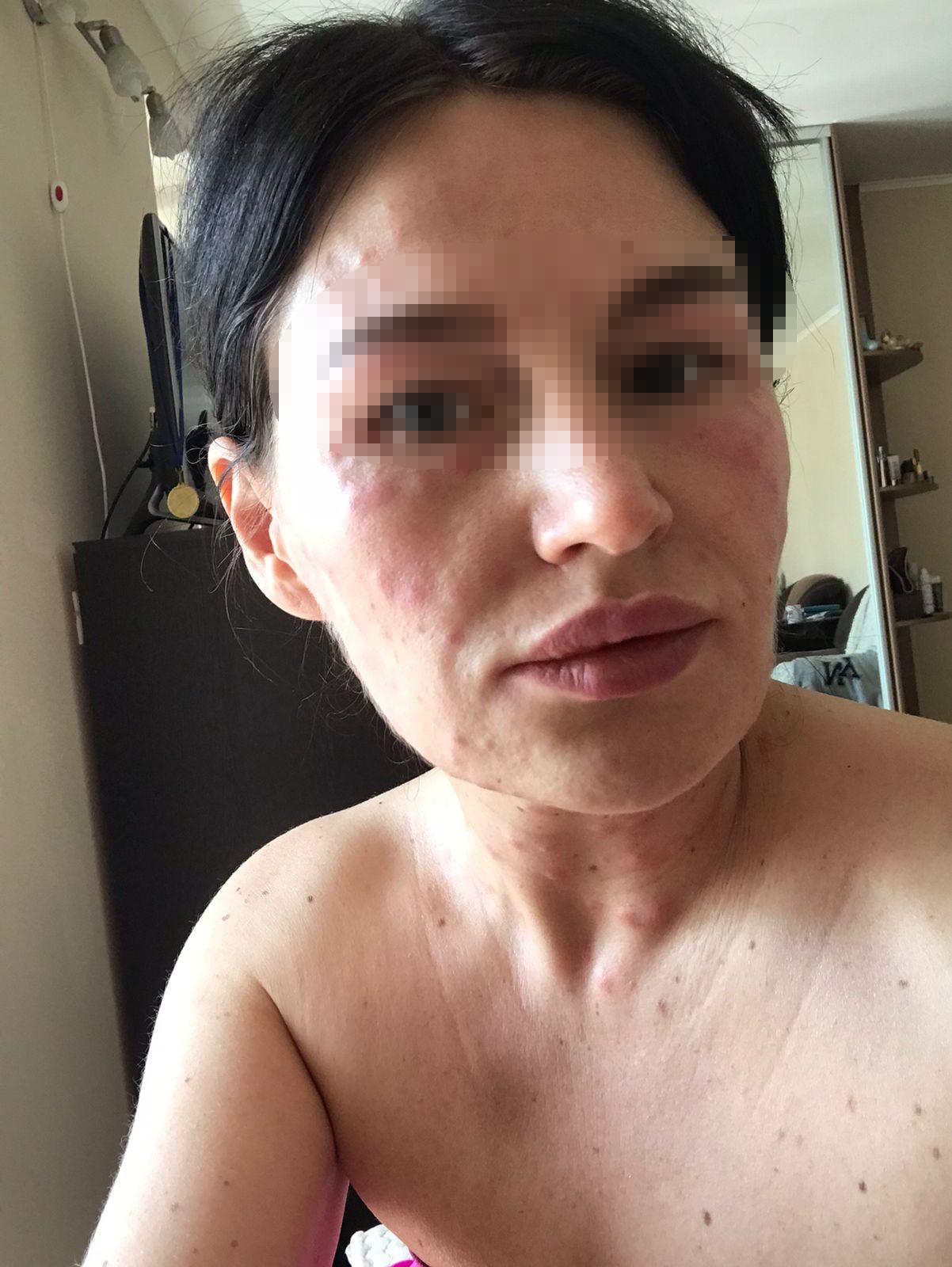 Фото «Будто кипяток под кожей»: жительница Новосибирска получила отёк Квинке после процедуры у косметолога на дому 6