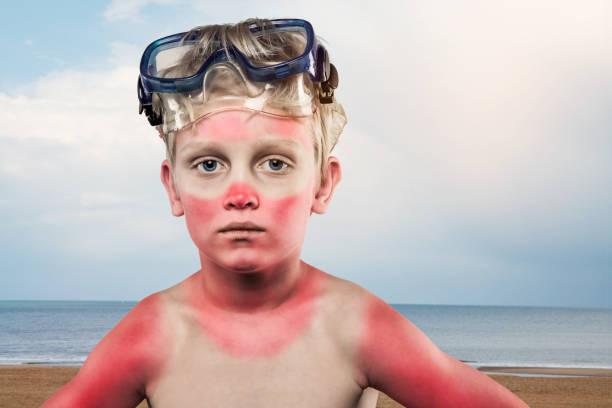 Фото Рак кожи после загара: чем опасны волдыри и покраснения от агрессивного солнца 5