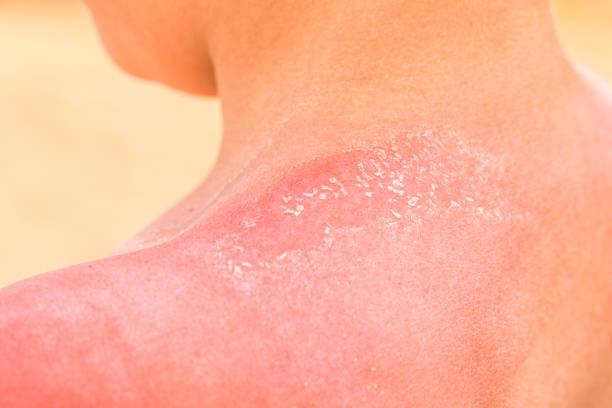 Фото Рак кожи после загара: чем опасны волдыри и покраснения от агрессивного солнца 7